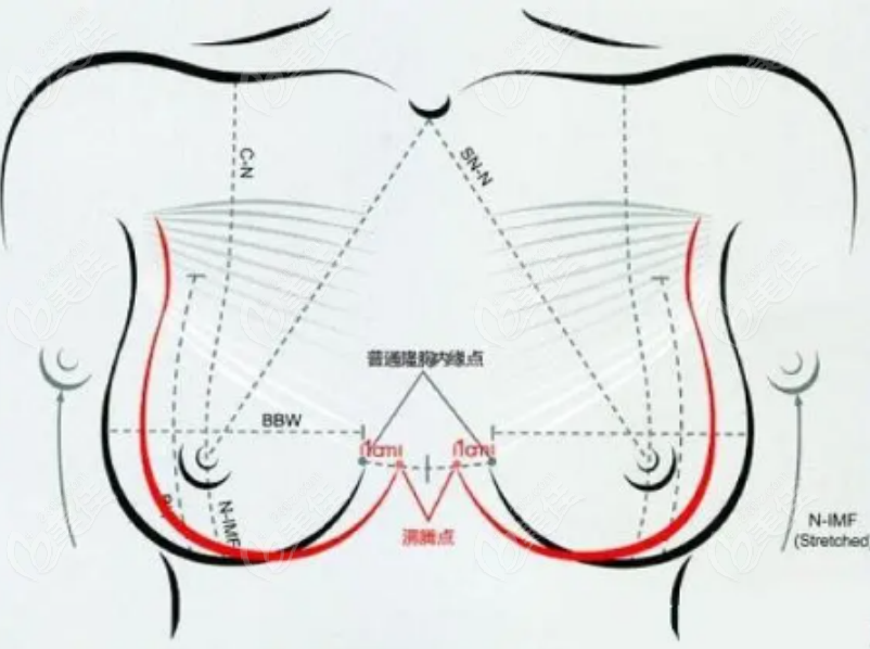 巨乳缩小手术