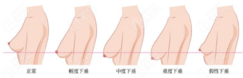 巨乳缩小手术