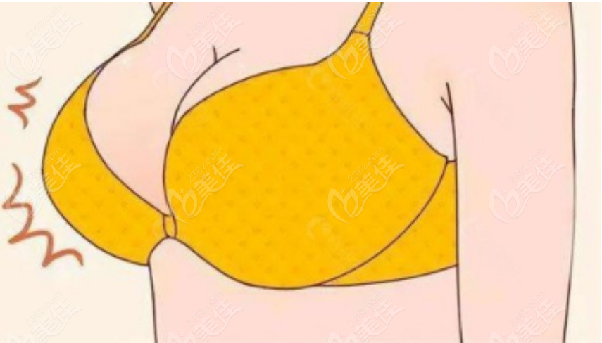 巨乳缩小手术