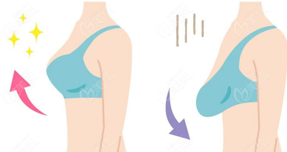 巨乳缩小手术