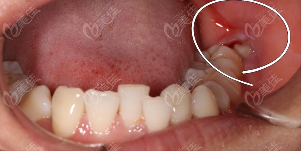 深圳牙科拔牙多少钱一颗