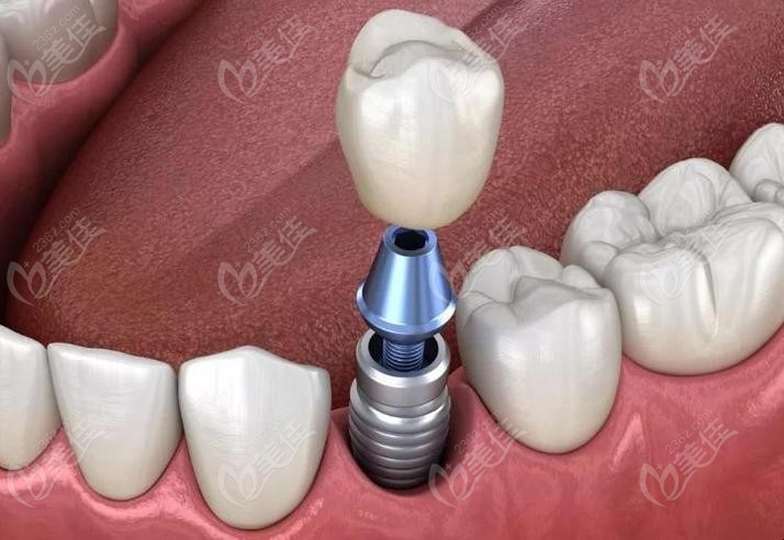 深圳周凌医生种植牙怎么样