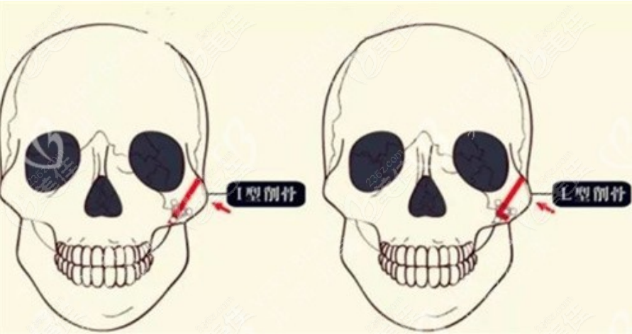 下颌角截骨手术示意图