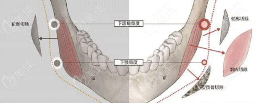 下颌角手术示意图