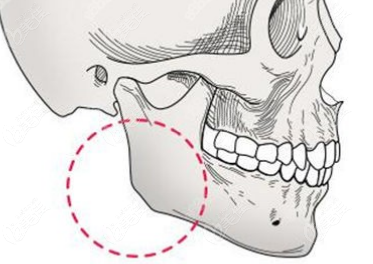 下颌角手术示意图