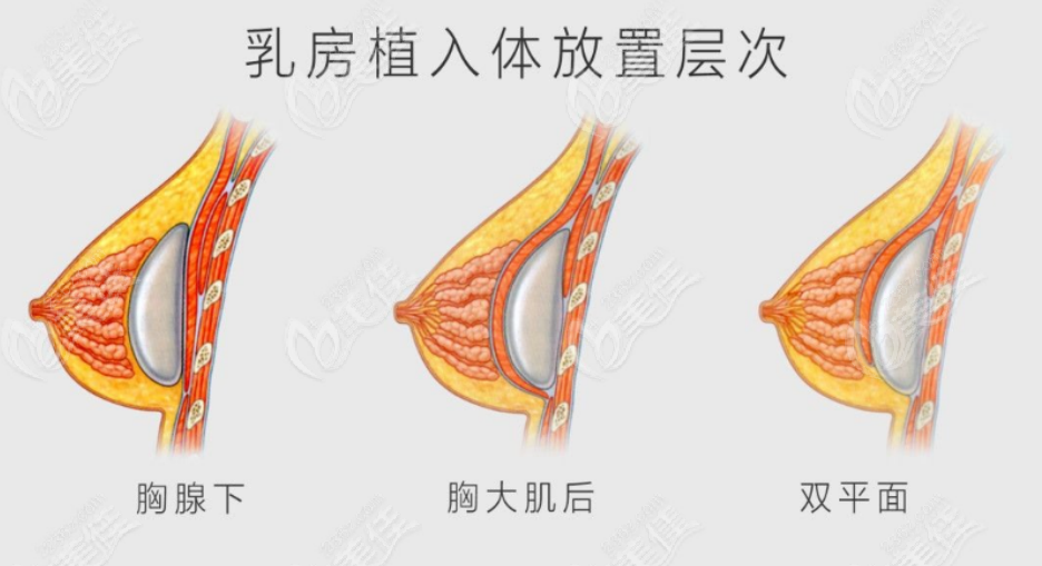 隆胸
