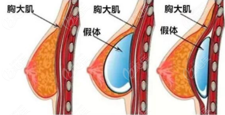 假体隆胸手术示意图