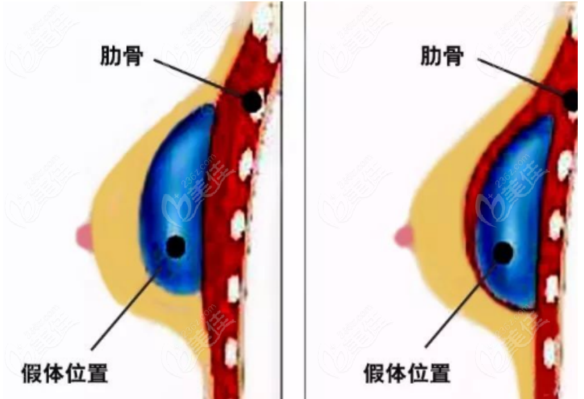 假体隆胸手术示意图