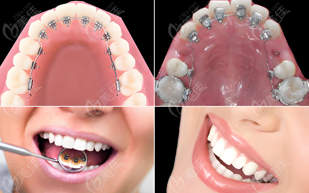 牙齿矫正方式的特点
