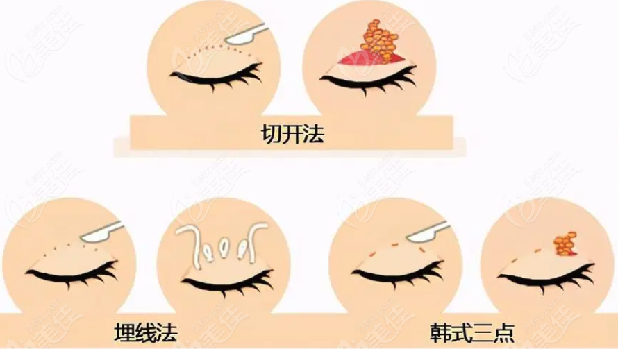 <!--<i data=20240703-sp></i>-->修复双眼皮到底好不好