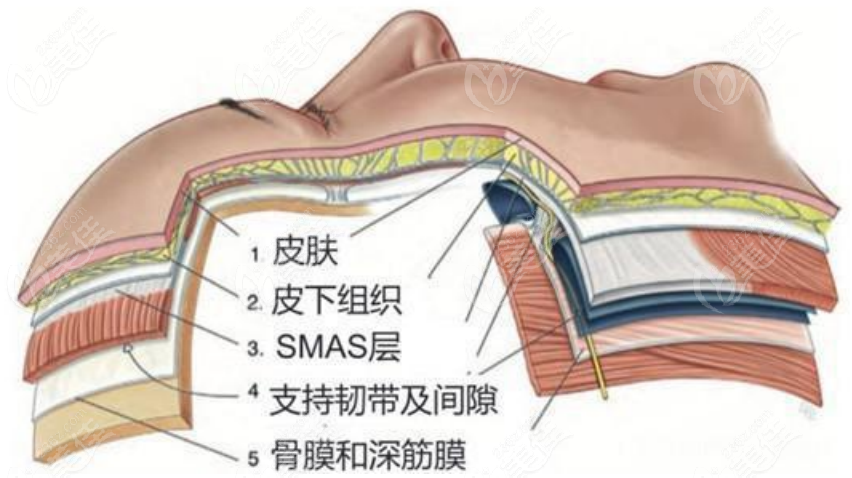 236z.com面部提升手术示意图