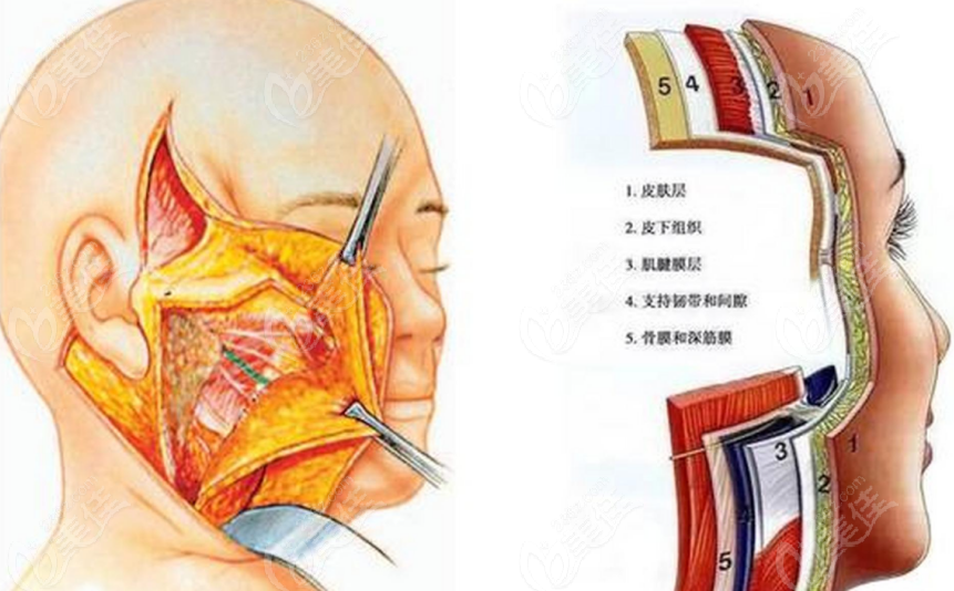 面部提升手术示意图