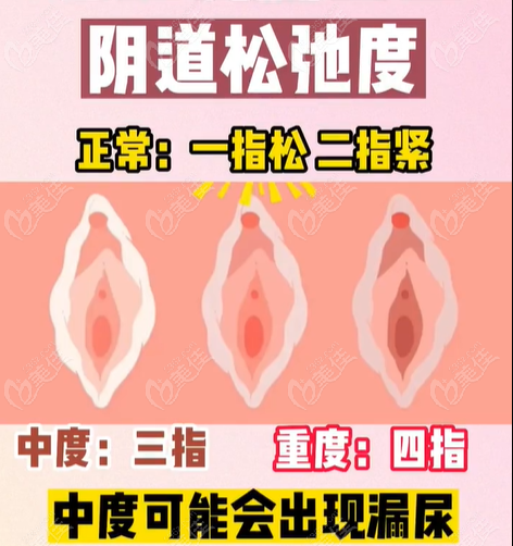 产后松弛修复技术优势