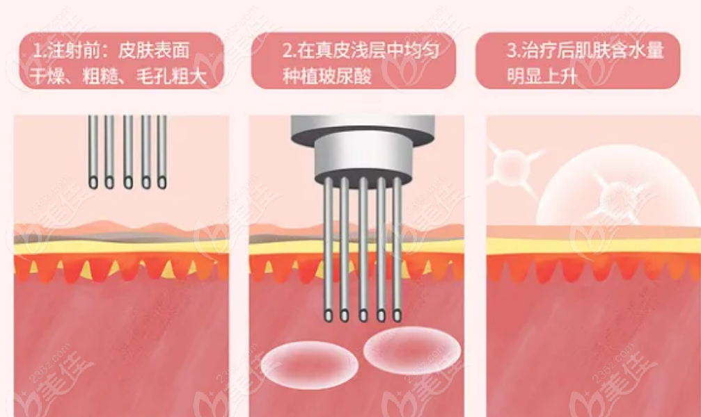 注射juvelook韩国胶原蛋白多久有疗效