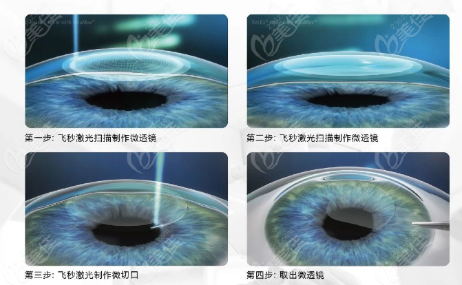 北京民众眼科闫庆慧全飞秒近视矫正技术好