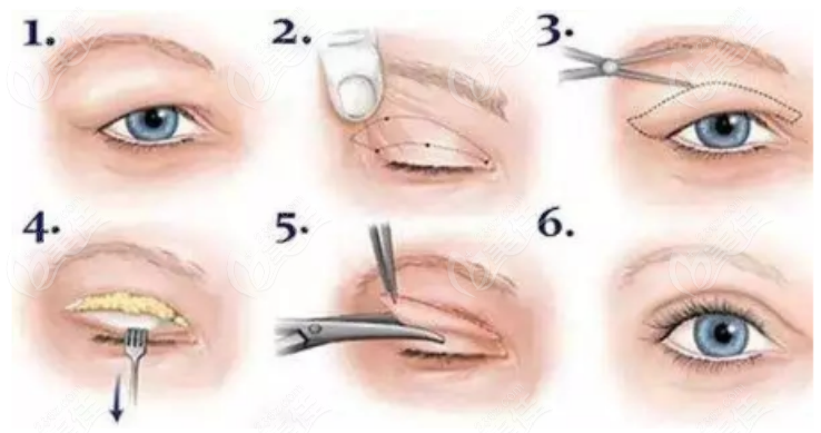 双眼皮手术示意图