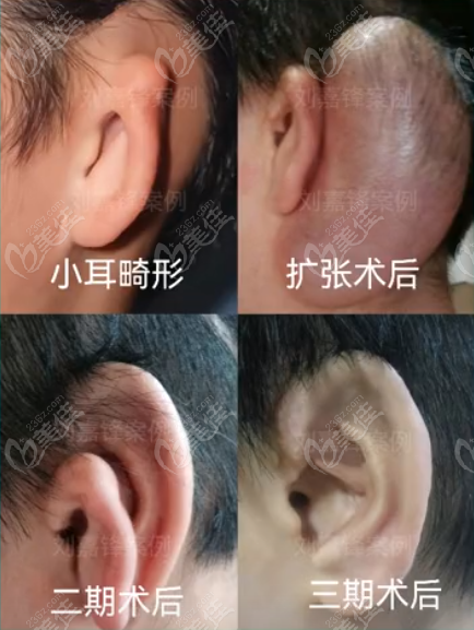 刘嘉锋外耳再造真人实例