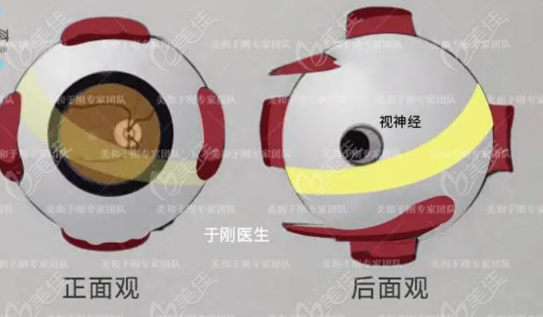 改良的兜带式后巩膜加固术