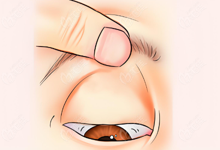 雙眼皮修復(fù)