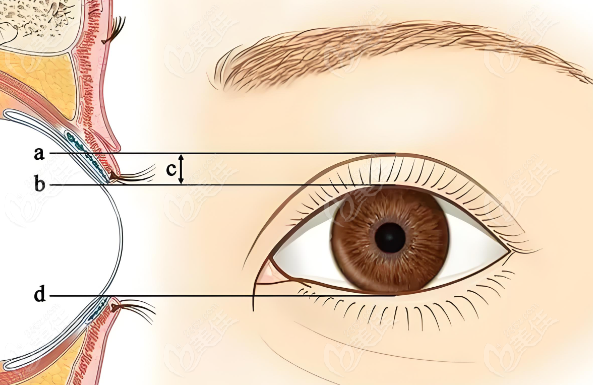徐曉斐雙眼皮修復(fù)技術(shù)好實(shí)力到位www.pfflawyer.com