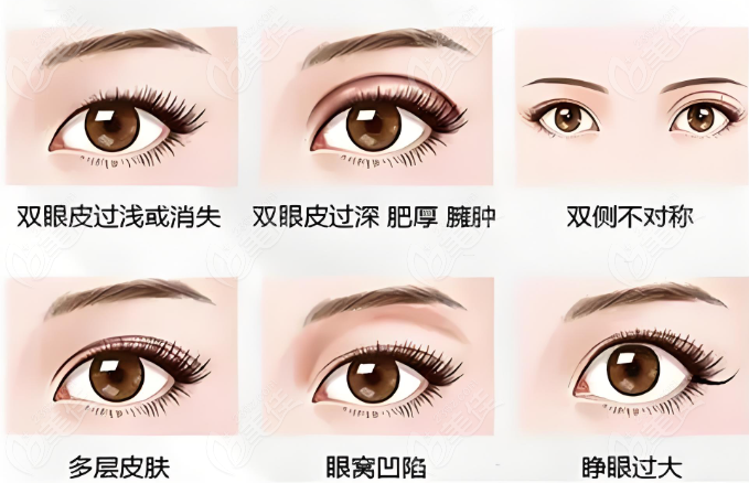 林靖医生双眼皮修复满意度怎么样