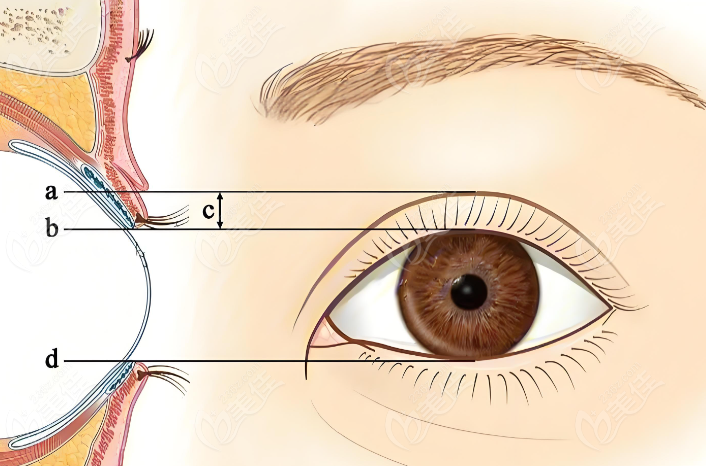 雙眼皮手術(shù)