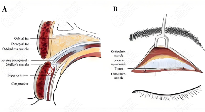 徐曉斐park法雙眼皮手術(shù)
