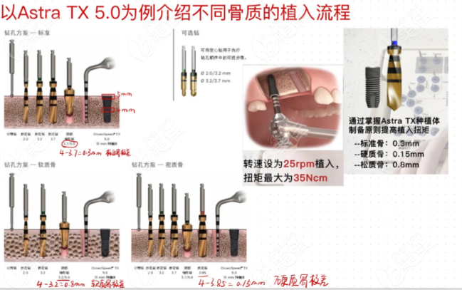 aastraTX适合不同骨质植入流程 aastraTX适合不同骨质植入流程