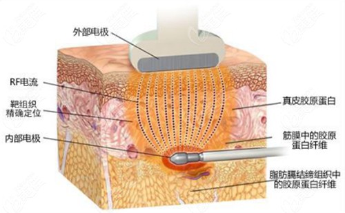 射频溶脂改善面部馒头化