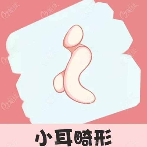 做耳再造手术前的耳朵III度畸形