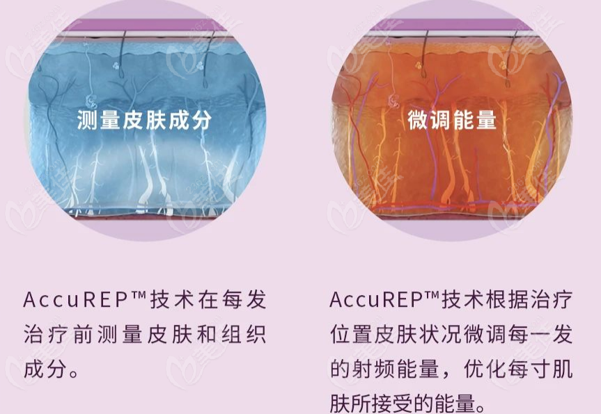 超玛吉升级了AccuREPTM技术