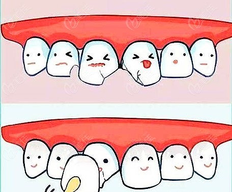 北京牙科医院全瓷牙价格