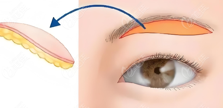 韩国soonplus双眼皮变成单眼皮手术技术好