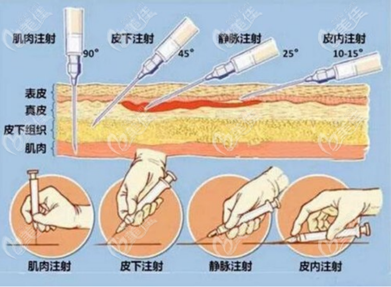 注射微整