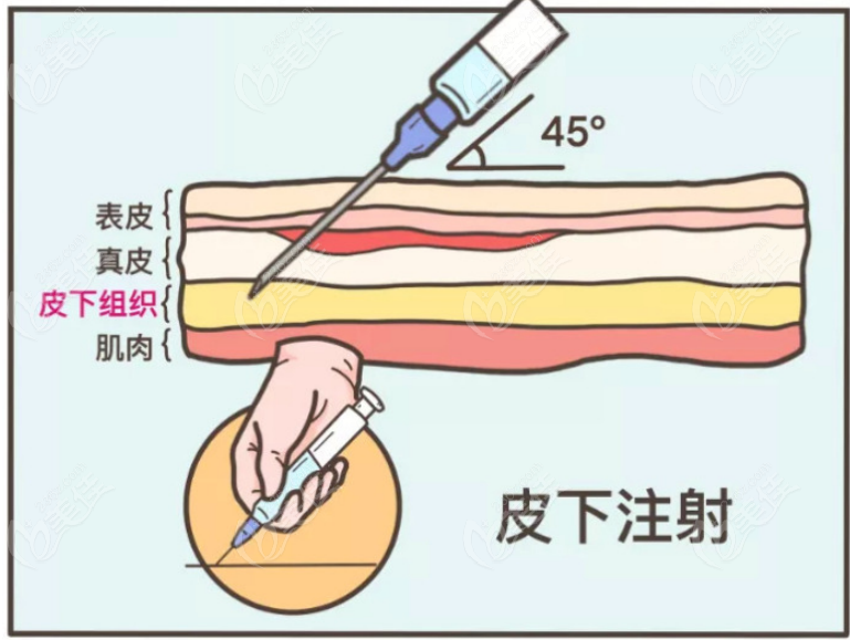 注射手术示意图