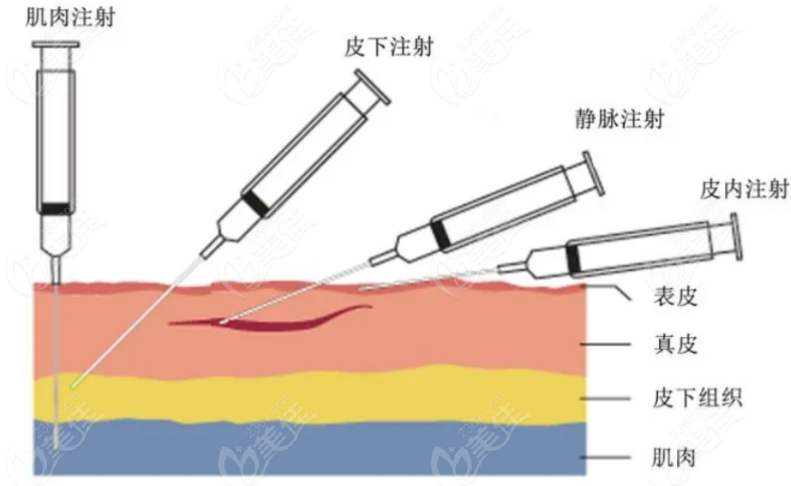 236z.com注射手术示意图