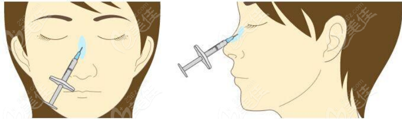 玻尿酸注射手術(shù)