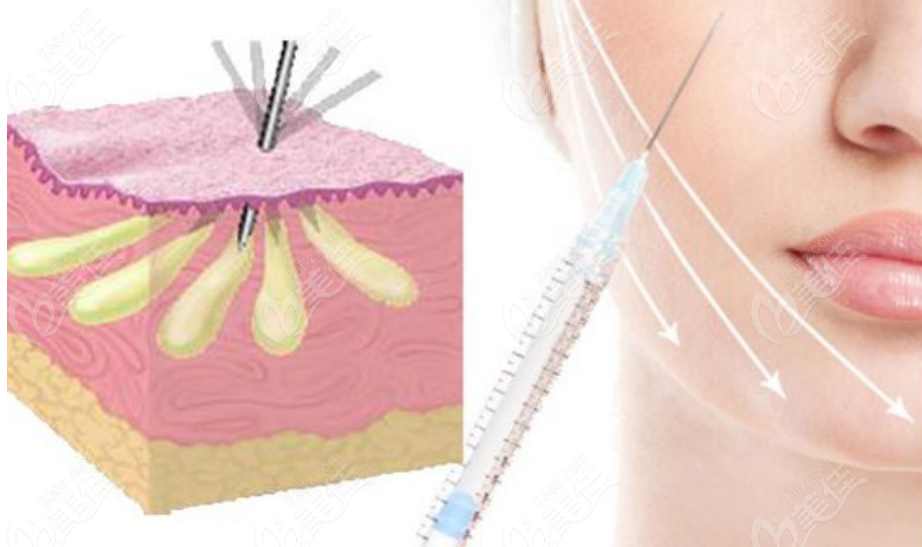 脂肪填充手术示意图