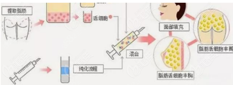 脂肪填充手术示意图