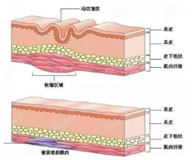 236z.com玻尿酸注射手术示意图