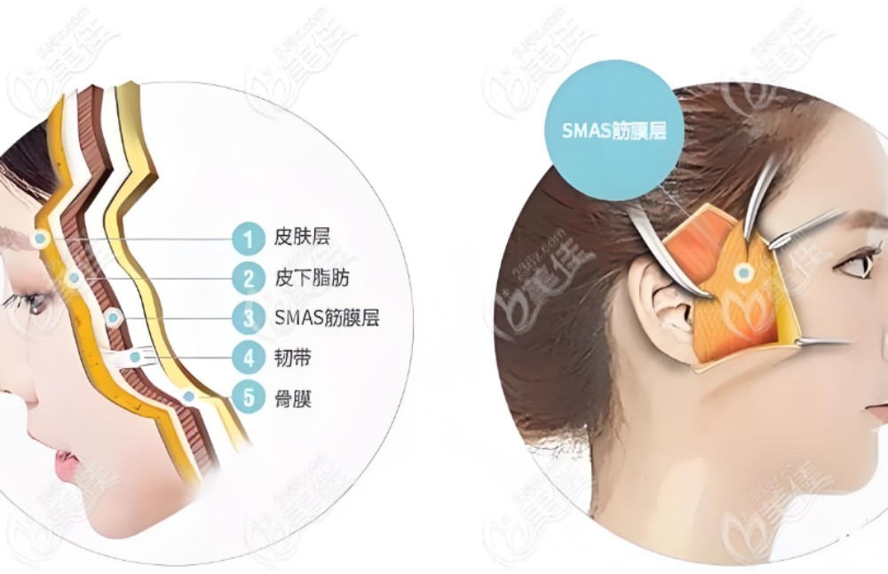 SMAS面部提升价格收费
