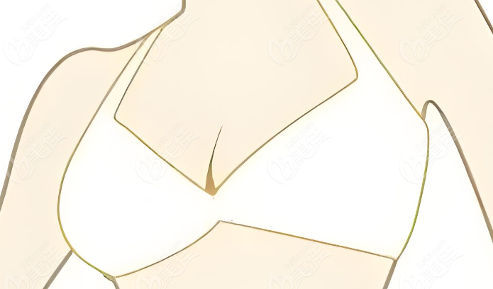 北京叶子李明技术怎么样？李明做假体隆胸手术技术特别好