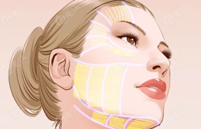 北京叶子李明做小切口筋膜提升怎么样？不错