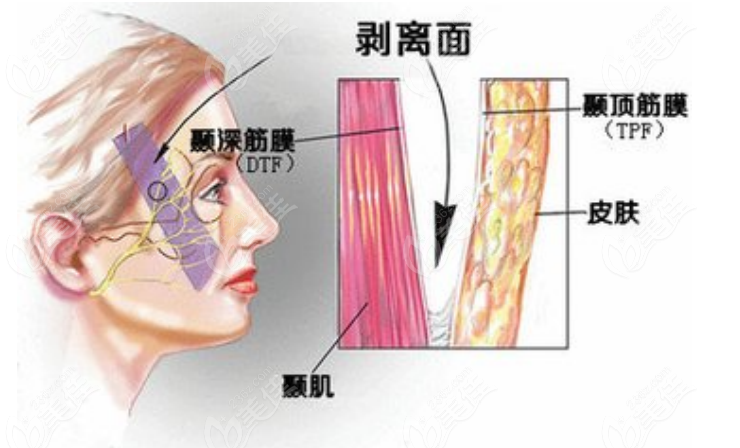 面部提升手术示意图