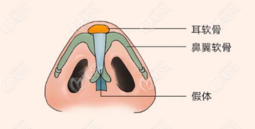 隆鼻手术示意图