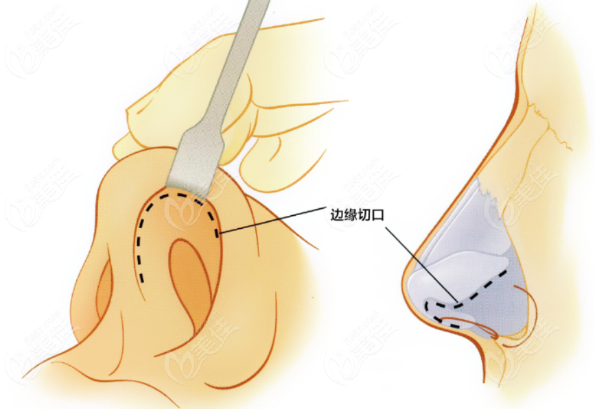 隆鼻手术示意图