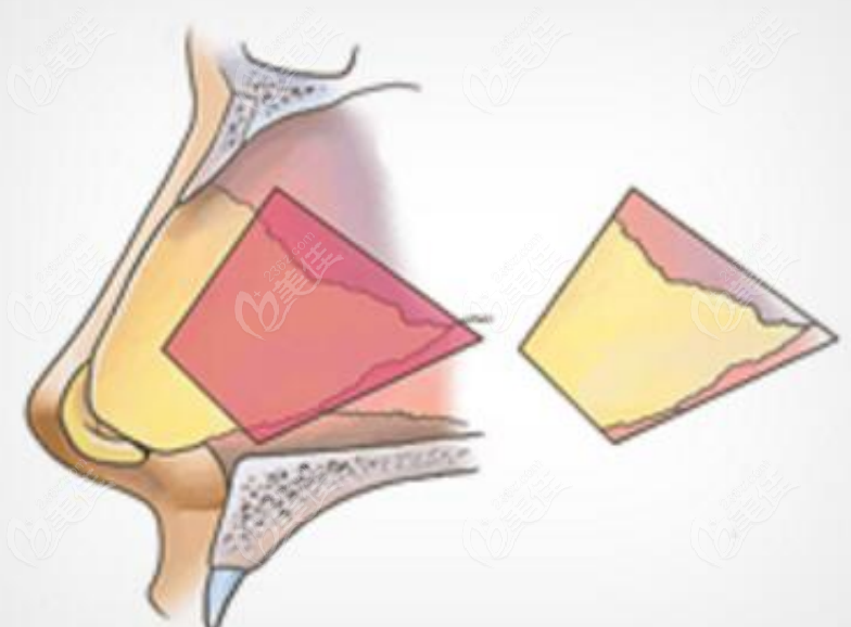 236z.com隆鼻手术示意图