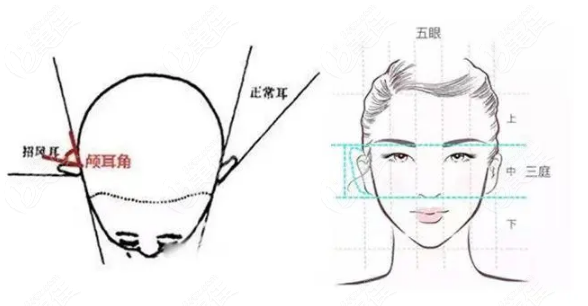 做假体精灵耳用硅胶和膨体哪个好