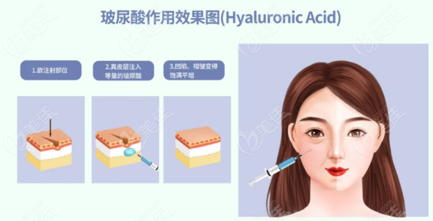 铂安润玻尿酸