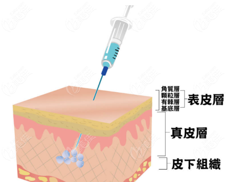 铂安润玻尿酸